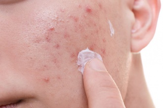 What You Need To Know Before Using Topical Antibiotics To Treat Your Acne